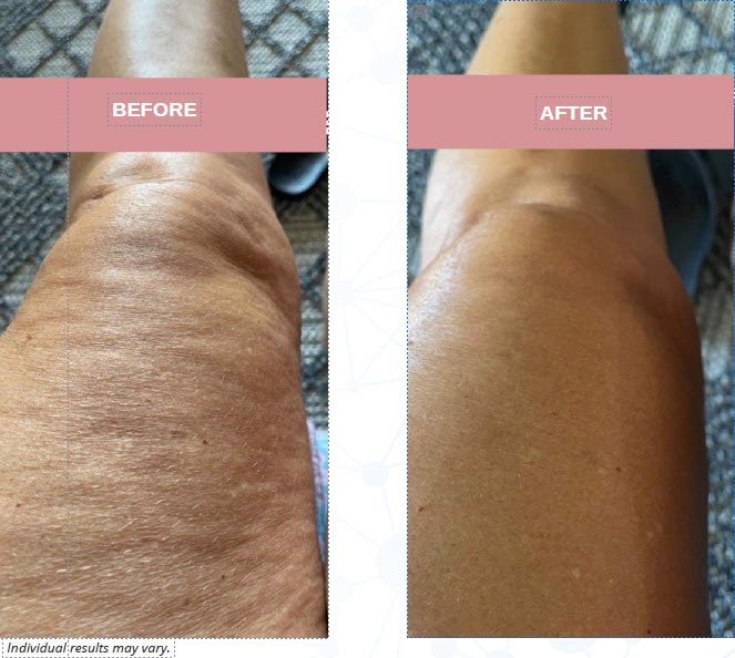 Arms, Legs and Body Treatment