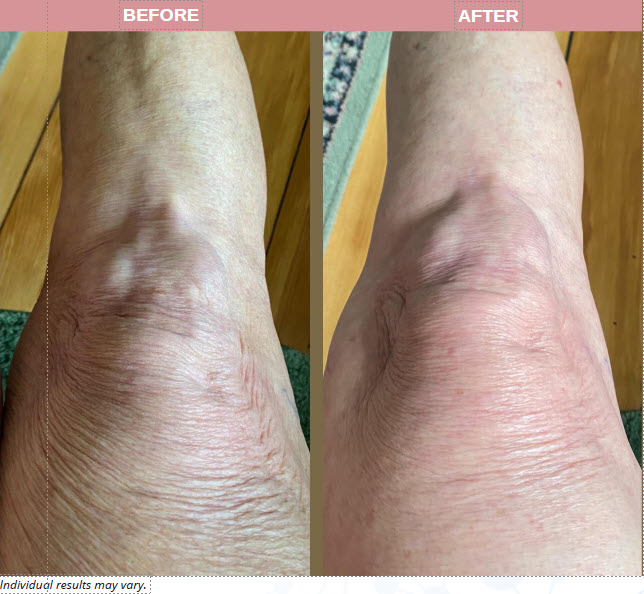 Arms, Legs and Body Treatment