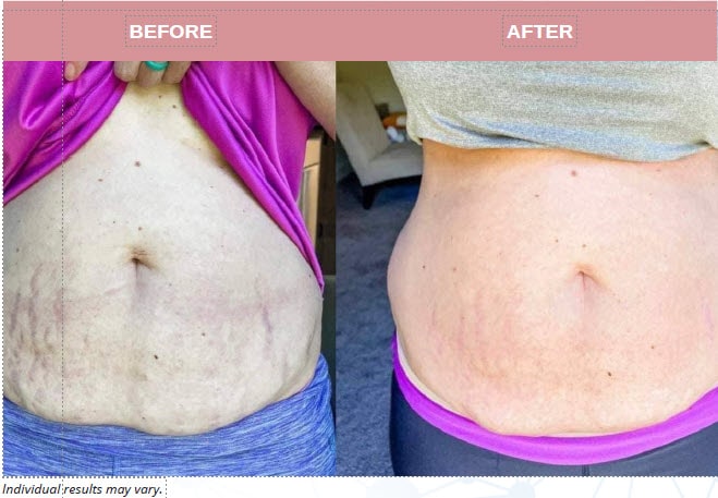 Arms, Legs and Body Treatment